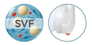 'Stromal Vascular Fraction (SVF)'란? 